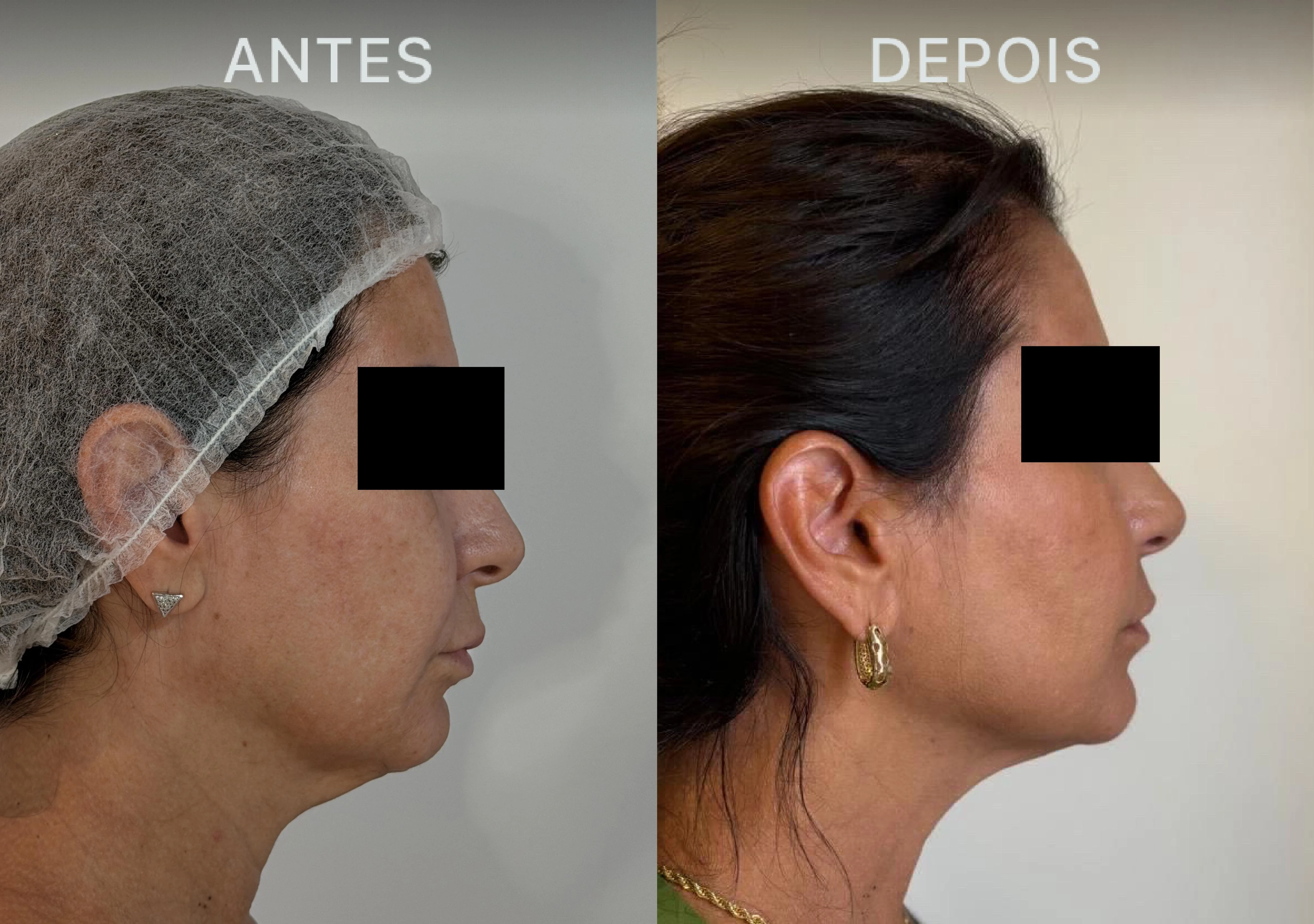 Antes e Depois Dra Lívia 10