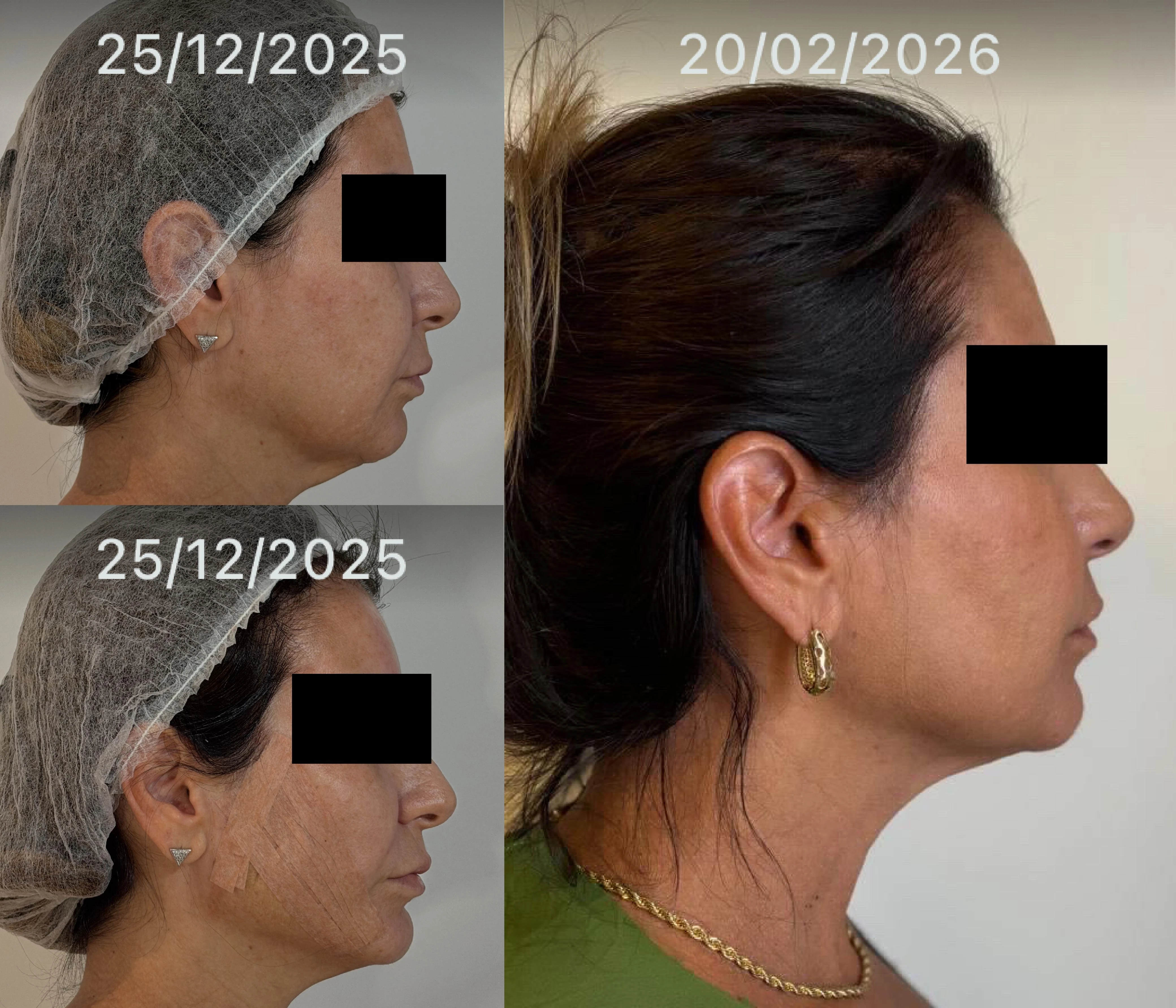 Antes e Depois Dra Lívia 12