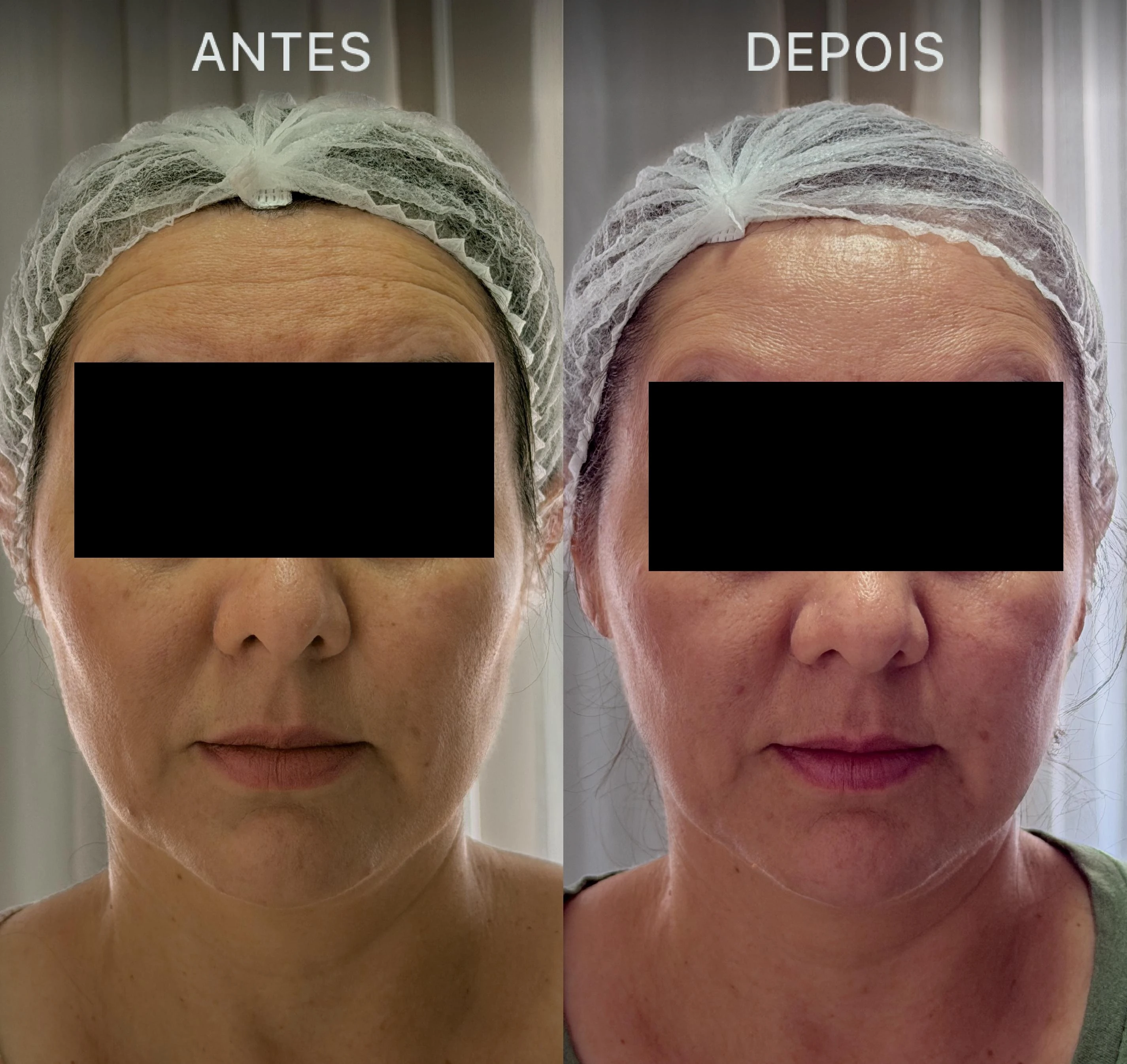 Antes e Depois Dra Lívia 13