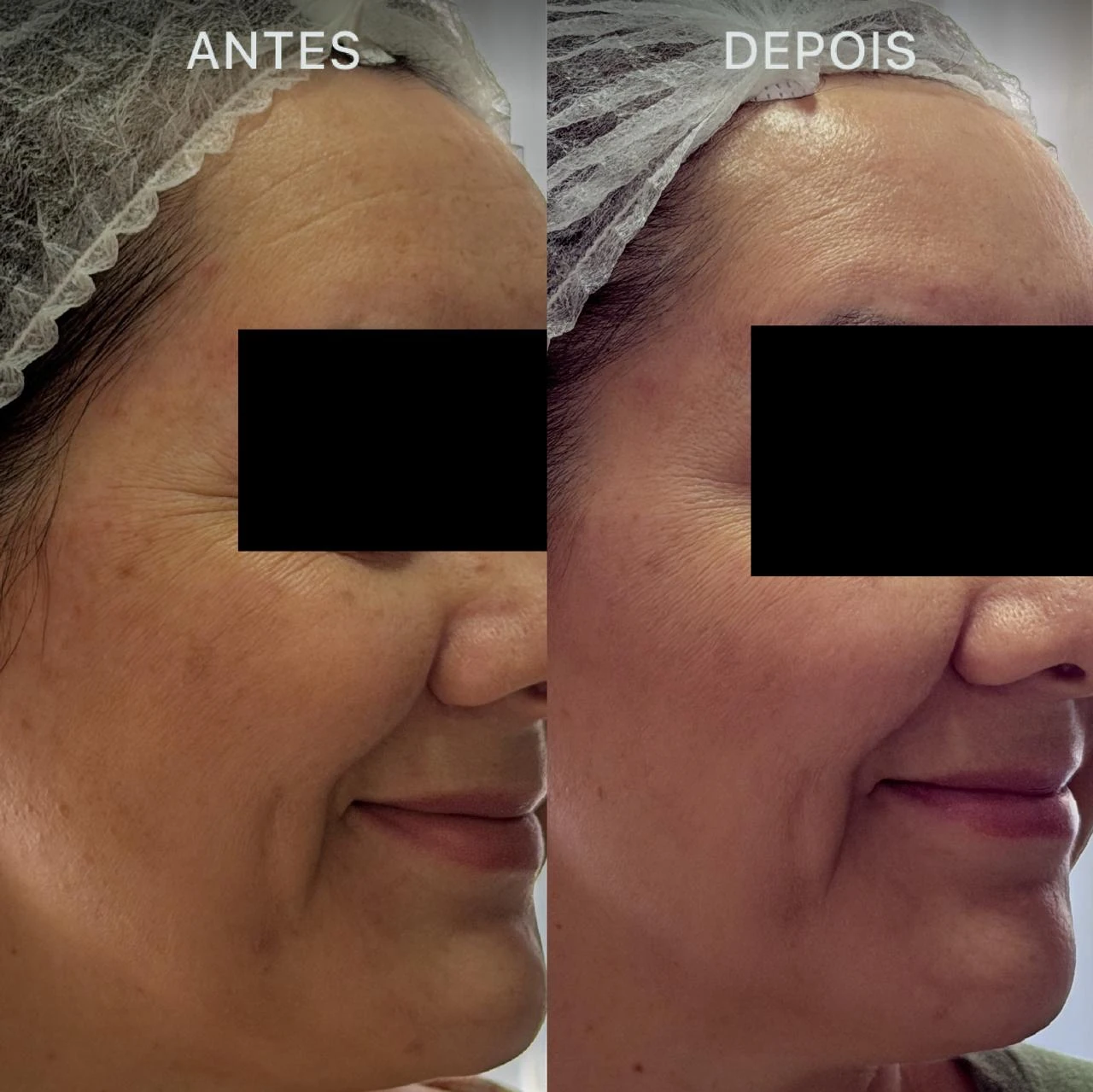 Antes e Depois Dra Lívia 14