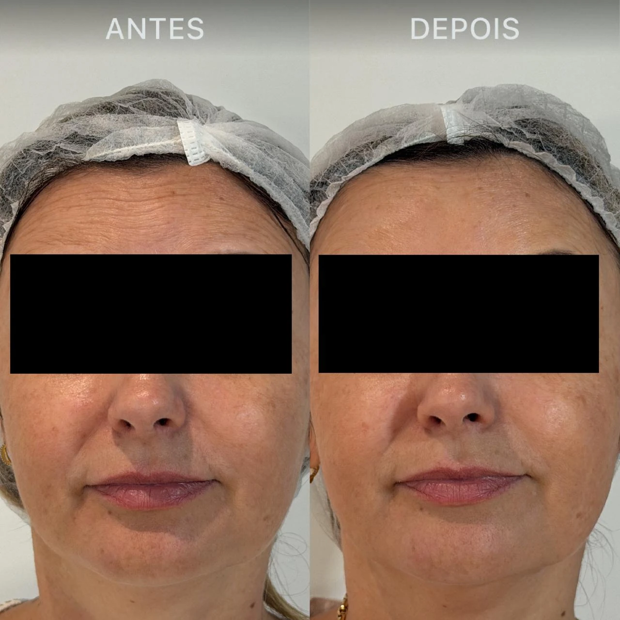 Antes e Depois Dra Lívia 15