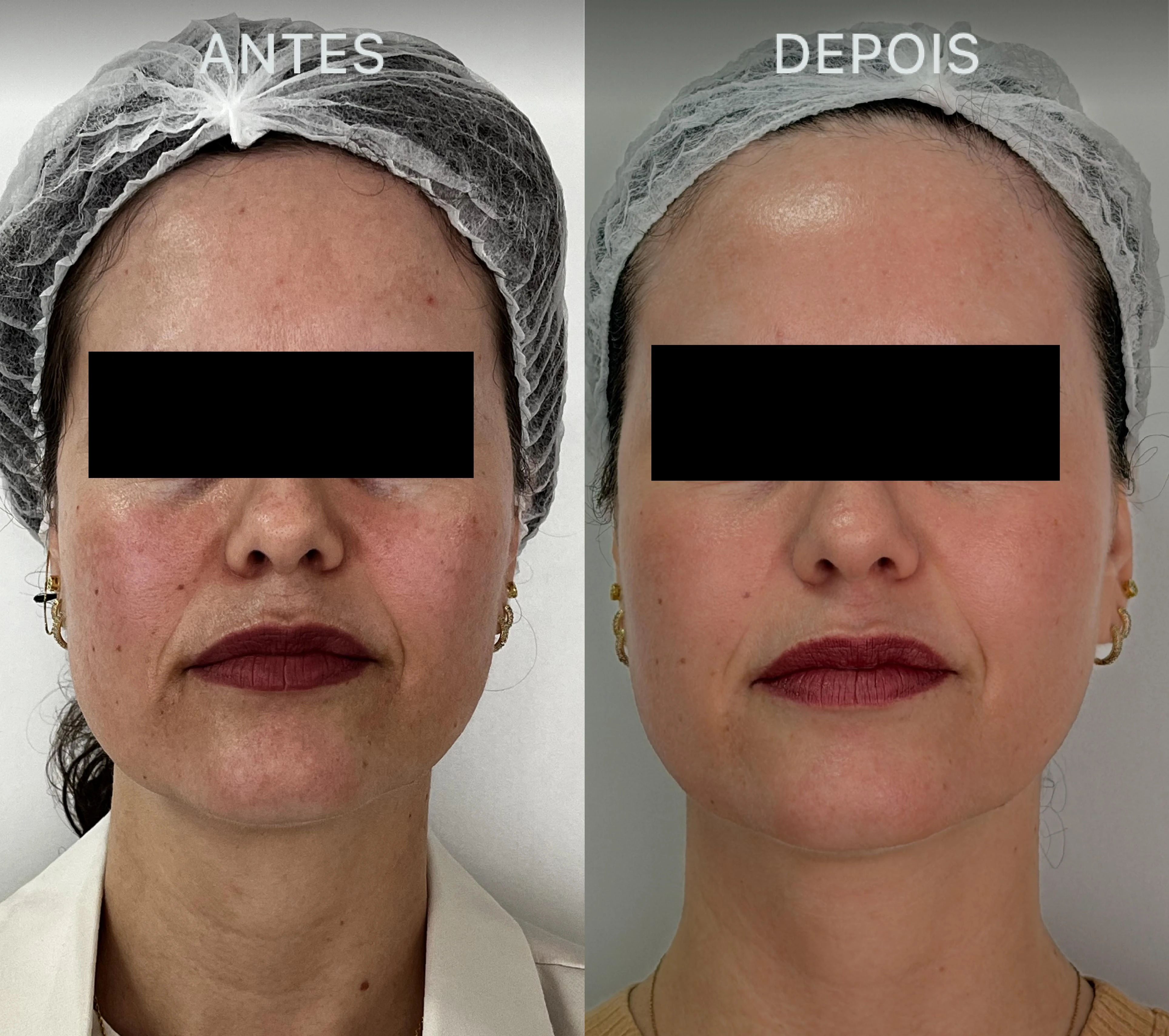 Antes e Depois Dra Lívia 20