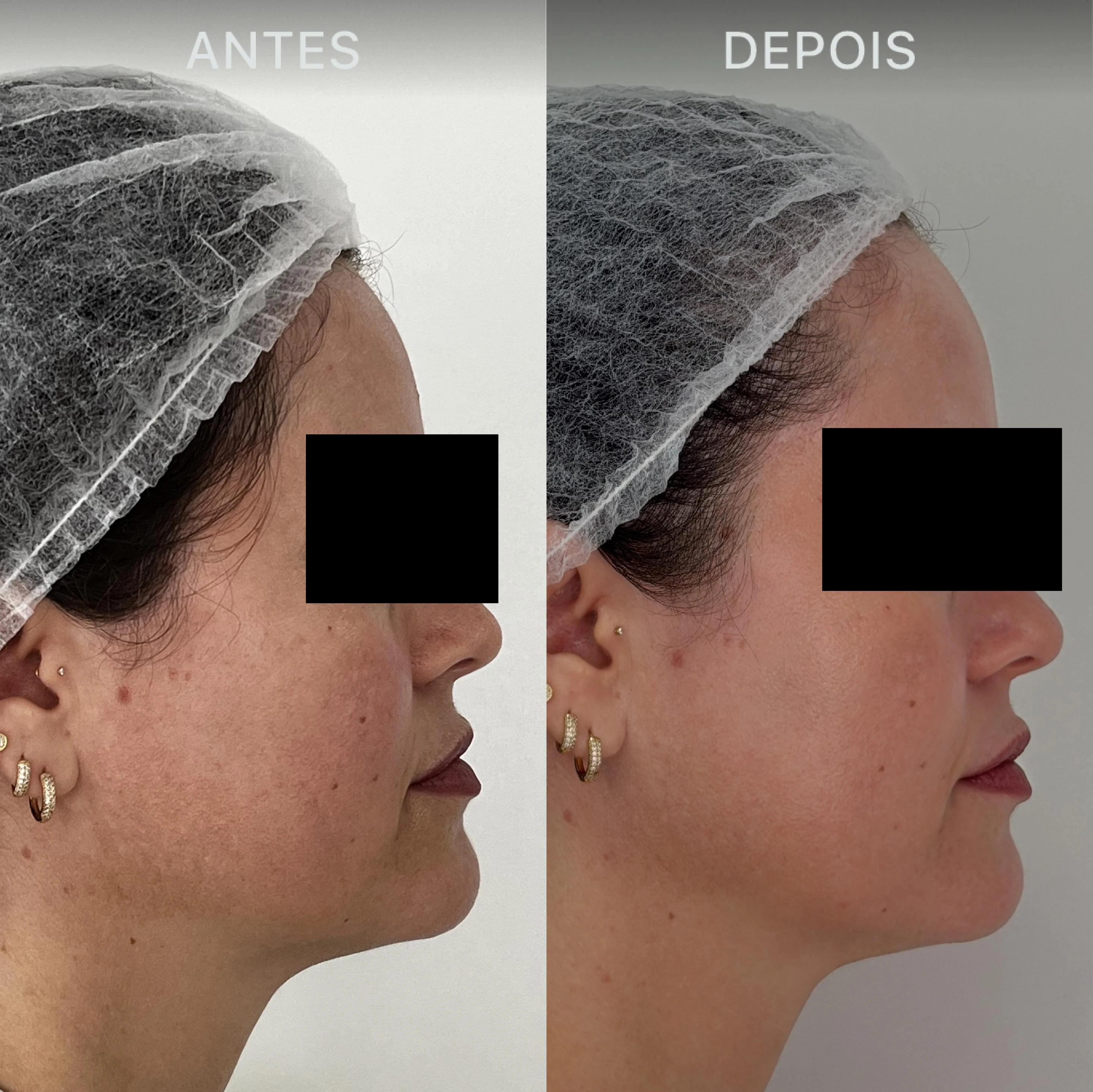 Antes e Depois Dra Lívia 21