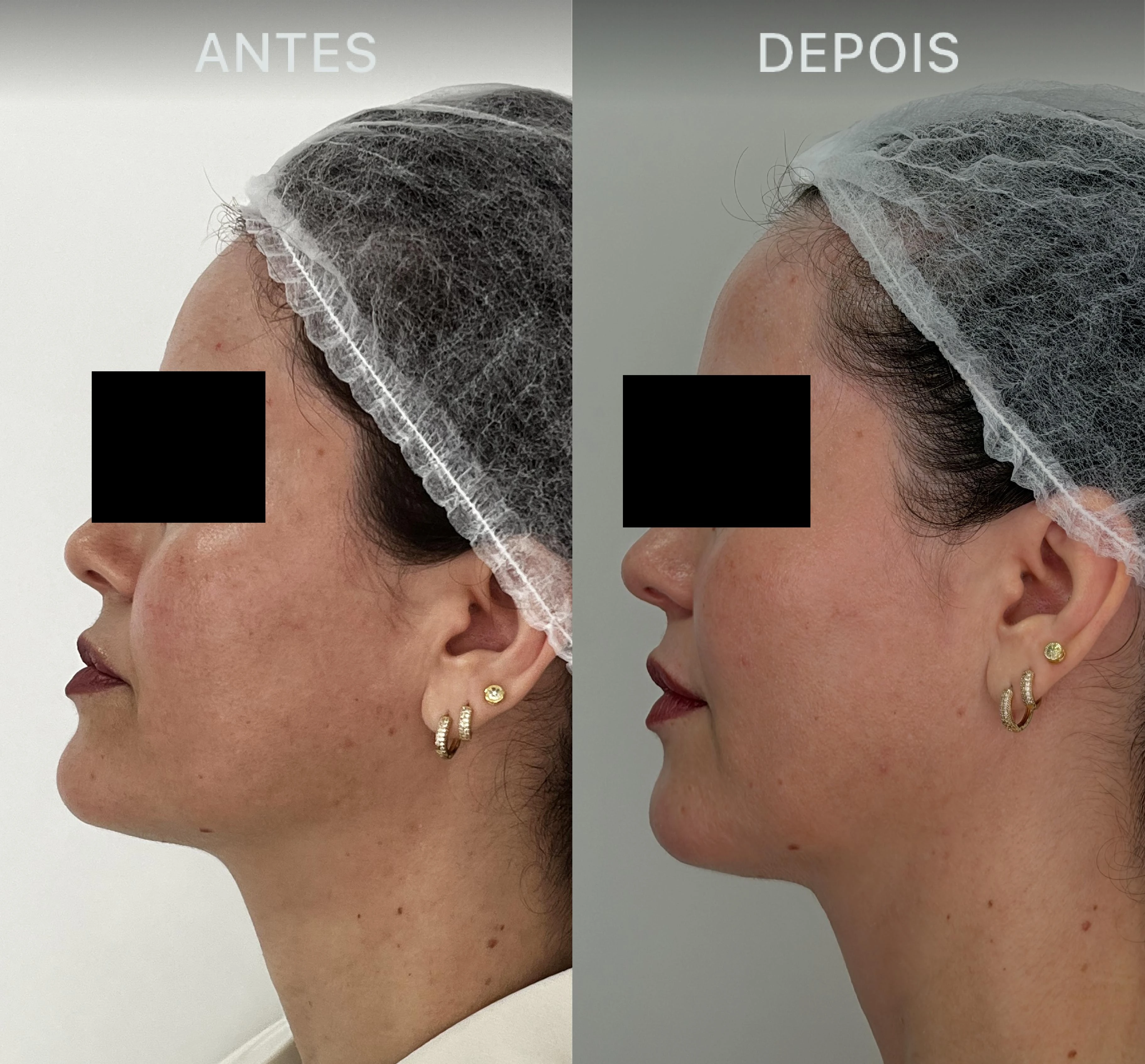 Antes e Depois Dra Lívia 22