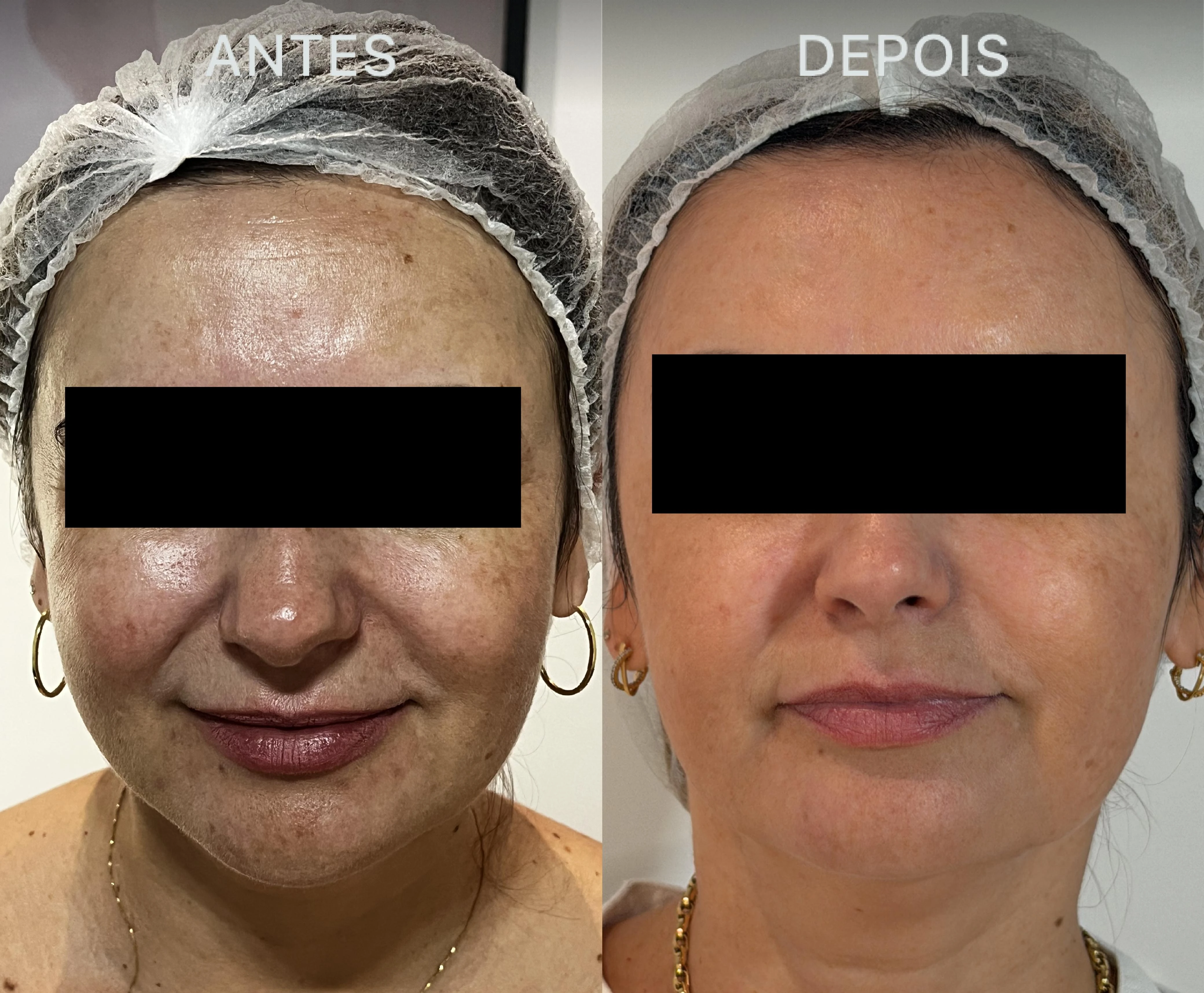 Antes e Depois Dra Lívia 28
