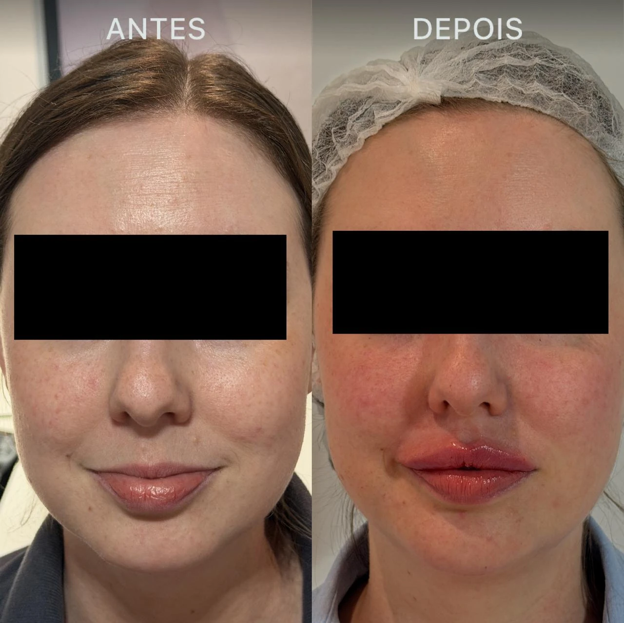 Antes e Depois Dra Lívia 30