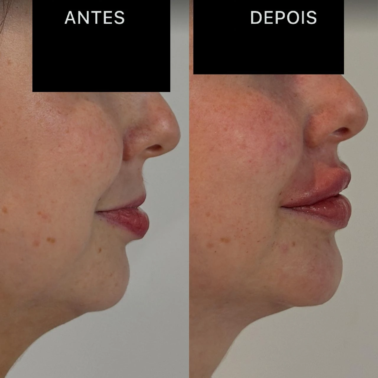 Antes e Depois Dra Lívia 31